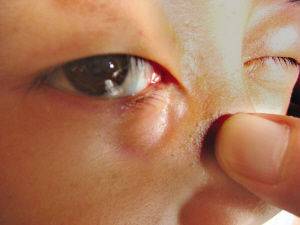 曼氏裂头蚴喜欢寄生在人体眼睛部位