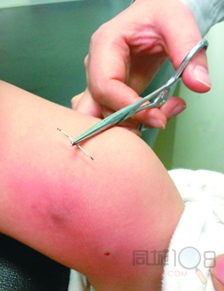     重庆商报讯 "疼,腿腿疼……"日前,2岁的小女孩秋晔经常喊左