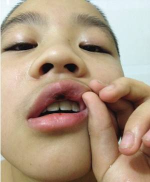 11岁男孩滑冰摔断两颗门牙 18岁前都不能用门牙吃饭