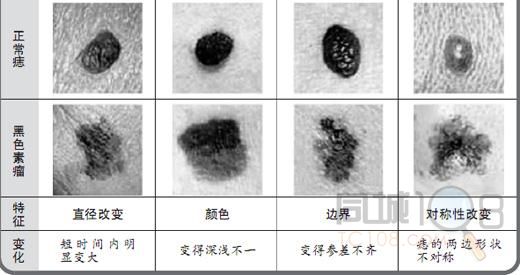 图说疾病:痣与黑色素瘤的区别 