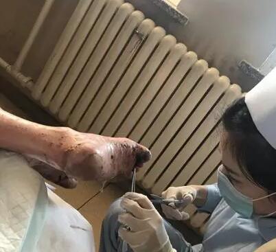 男子高烧40度全身溃烂成无皮人,只因一种常见药